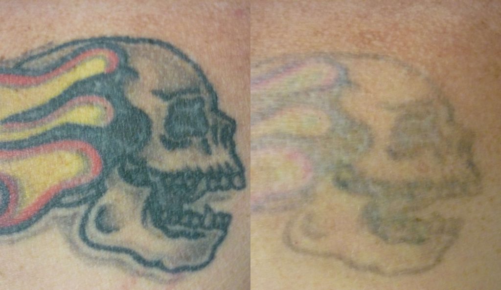 Coloured tattoo removal before and after Brisbane