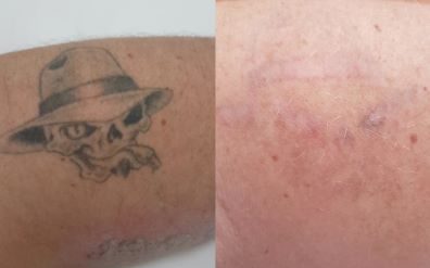 Laser Tattoo Removal Brisbane North